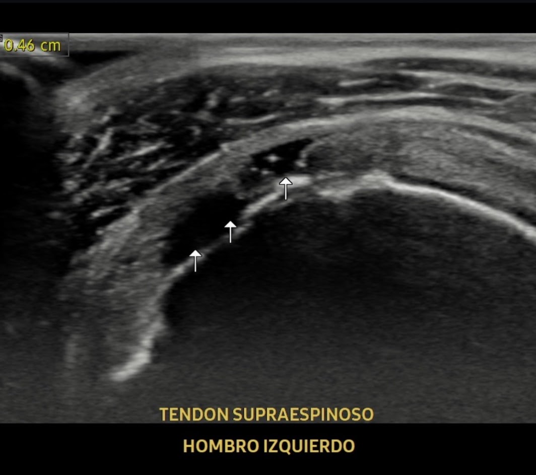 Ultrasonido tendón supraespinoso hombro izquierdo