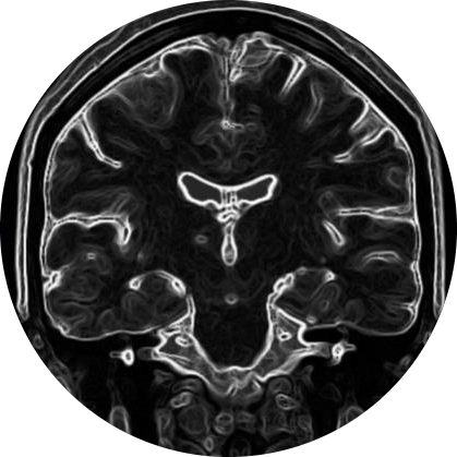 Resonancia magnética cerebro coronal
