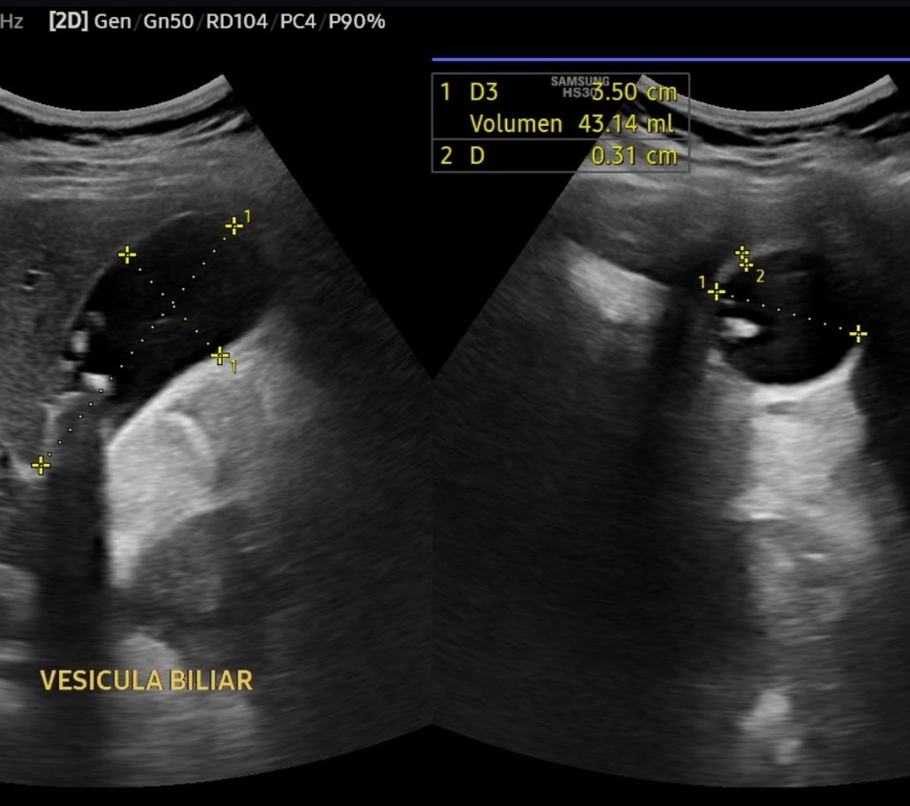 Ultrasonido vesícula biliar
