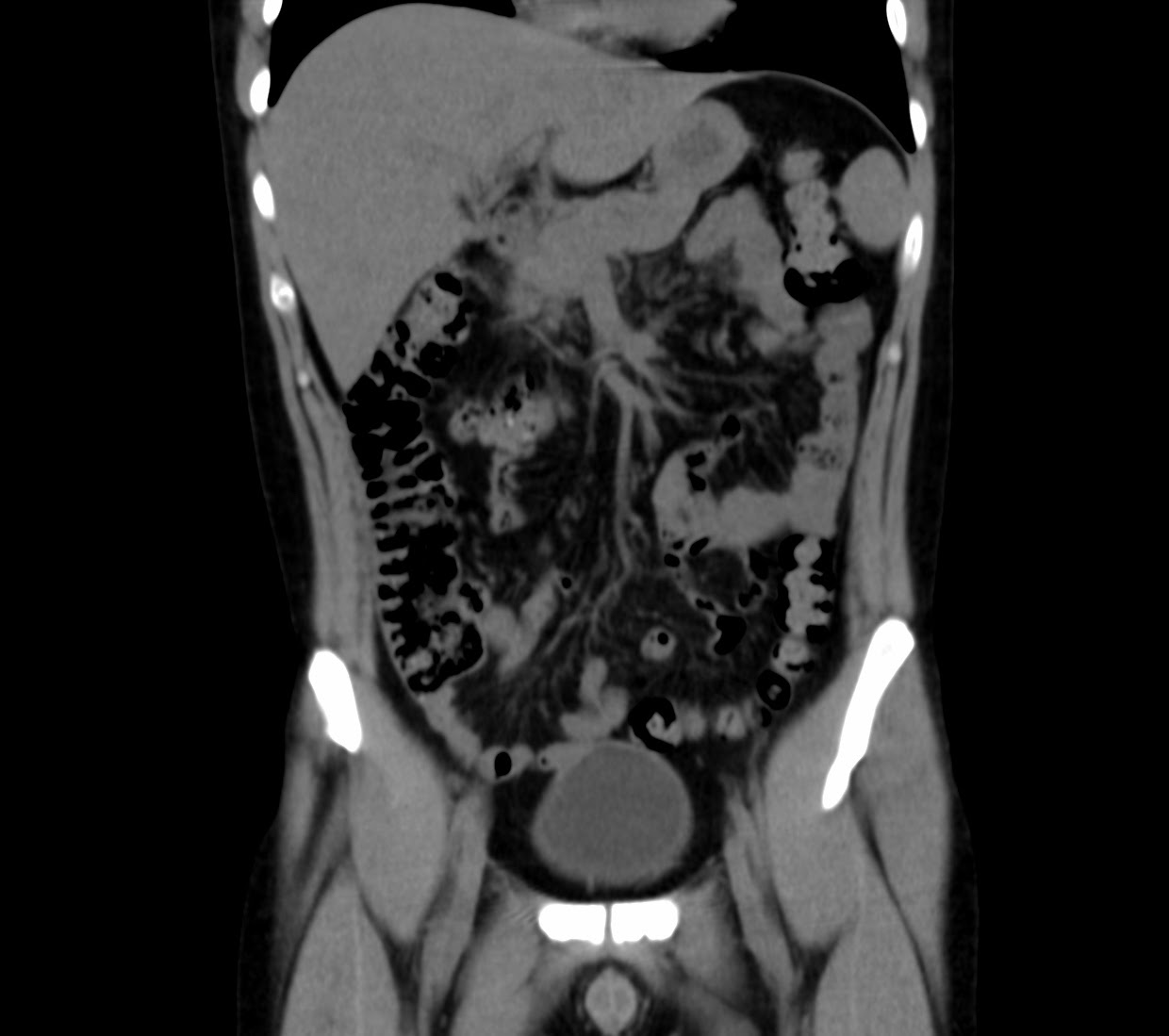 Tomografía de abdomen y pelvis coronal
