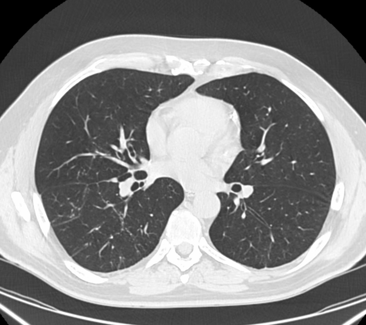 Tomografía de tórax ventana pulmonar